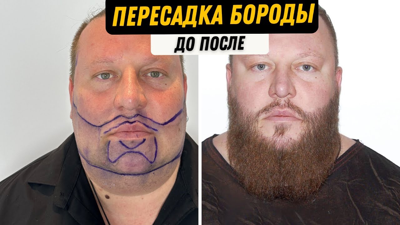 пересадка бороды в Турции До и После  #пересадкбороды