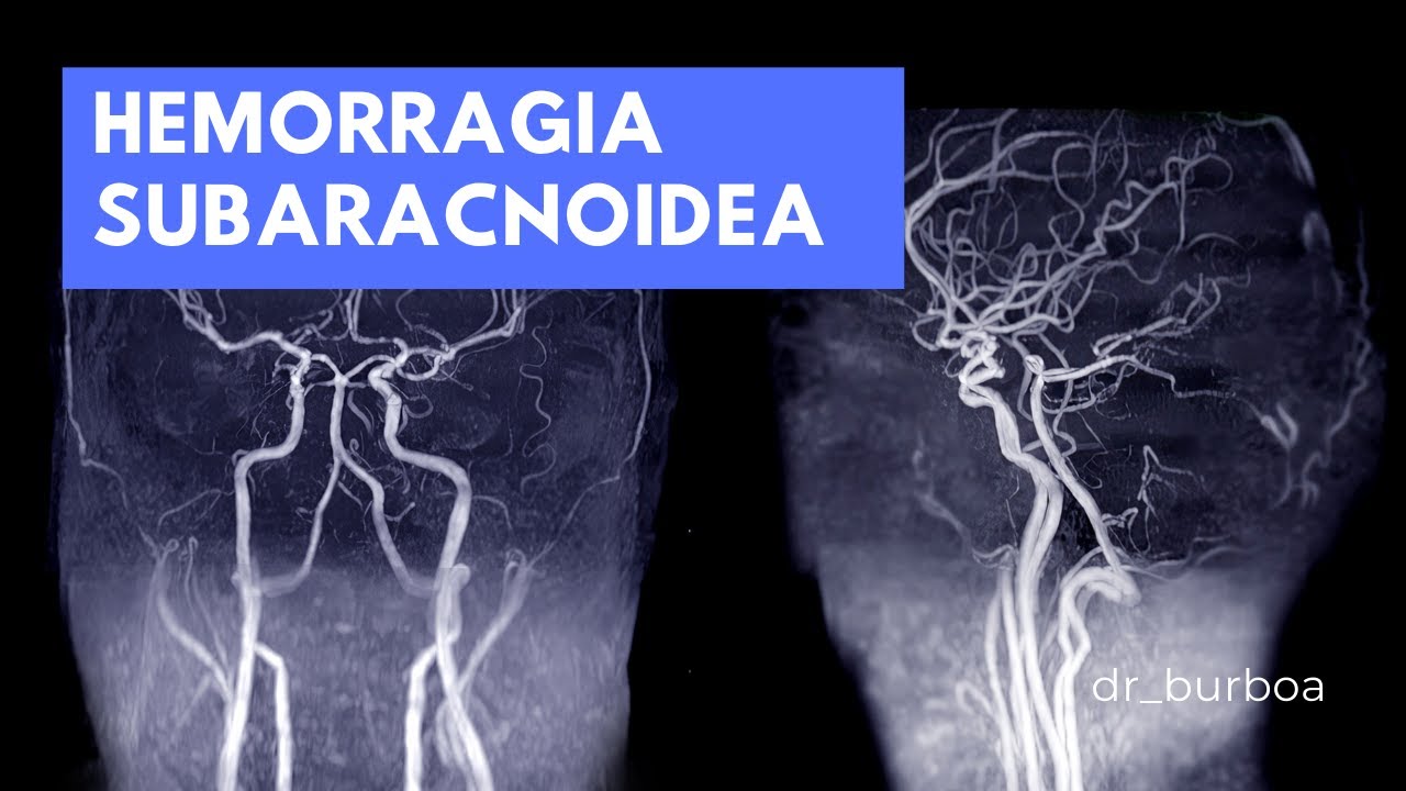 ANEURISMAS Y HEMORRAGIA SUBARACNOIDEA