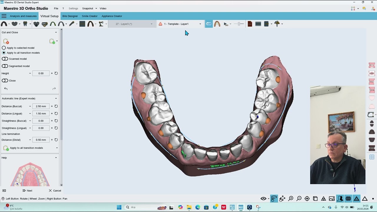 Maestro 3D Dental Studyo expert ,in-house  Aligners and DIY solutions Part 7 Staging model creating