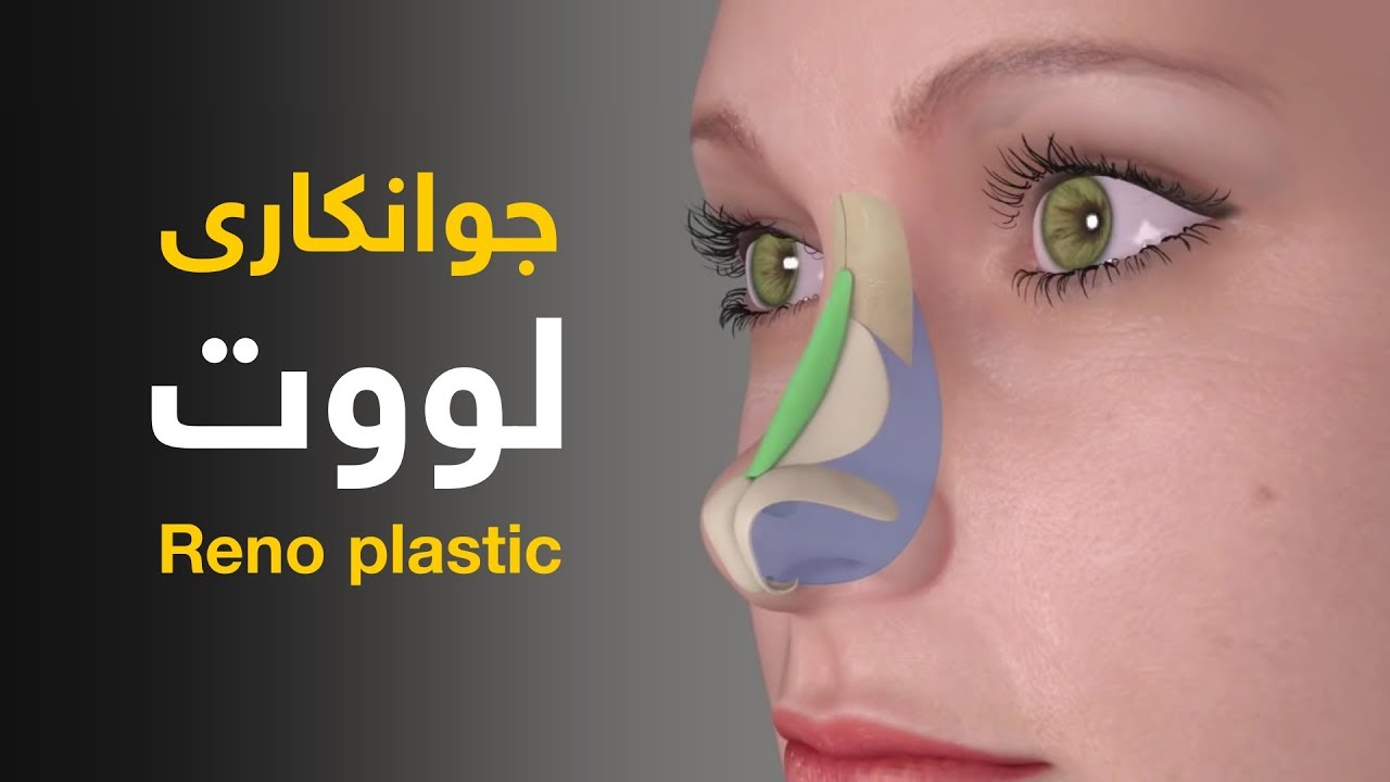 جوانکاری لووت Reno plastic