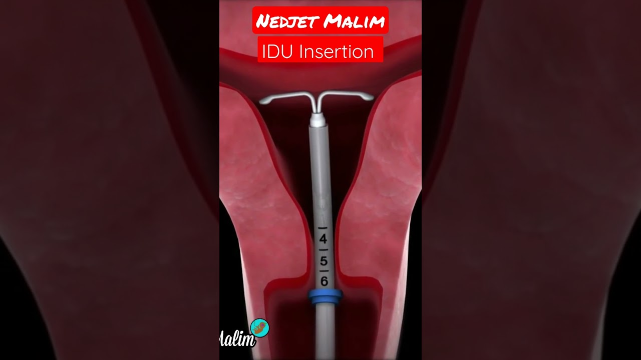 first period after mirena insertion #shorts #contraception