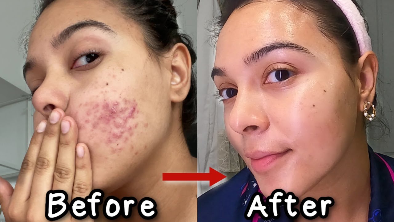 Как я избавилась от акне *3 продукта, которые изменили мою жизнь* | NataliesOutlet