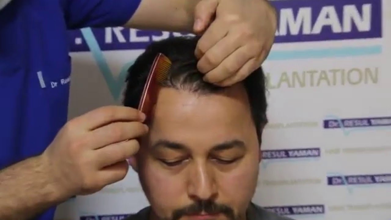 Patient Results for Dr.Resul Yaman - 3850 grafts