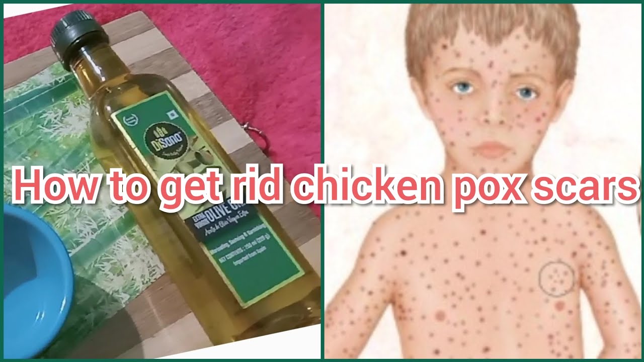 How to get rid chicken pox scars naturally// simple ingredients//effective remedies
