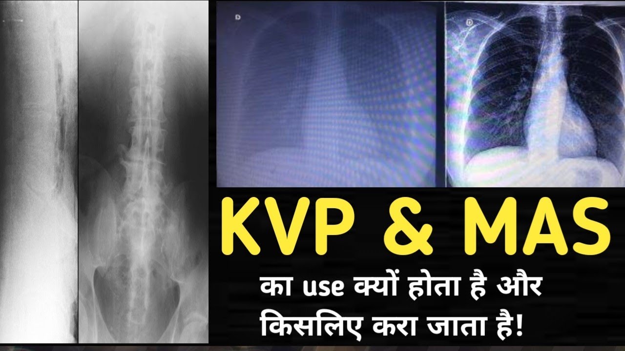Kvp & mas का x-ray me कैसे use होता है!और kvp & mas ज्यादा expose कर देने से क्या artifact आते है!