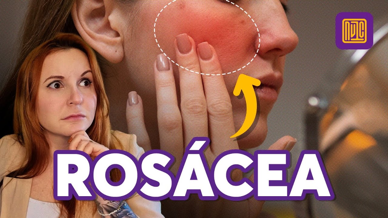 O que é rosácea e como tratar?
