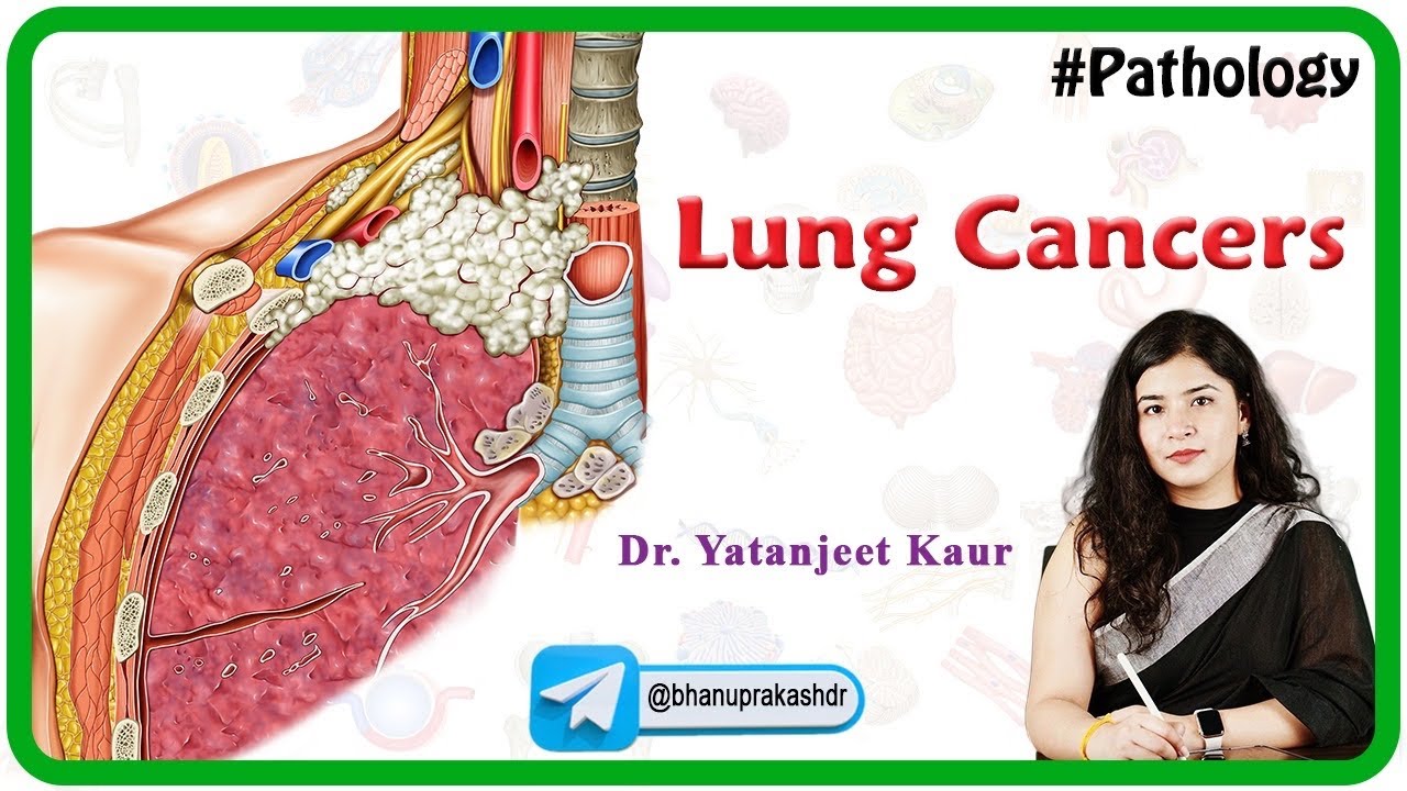 Lung Cancers Pathology In Hindi ( Benign and Malignant ) : MBBS, USMLE, Neet PG and FMGE