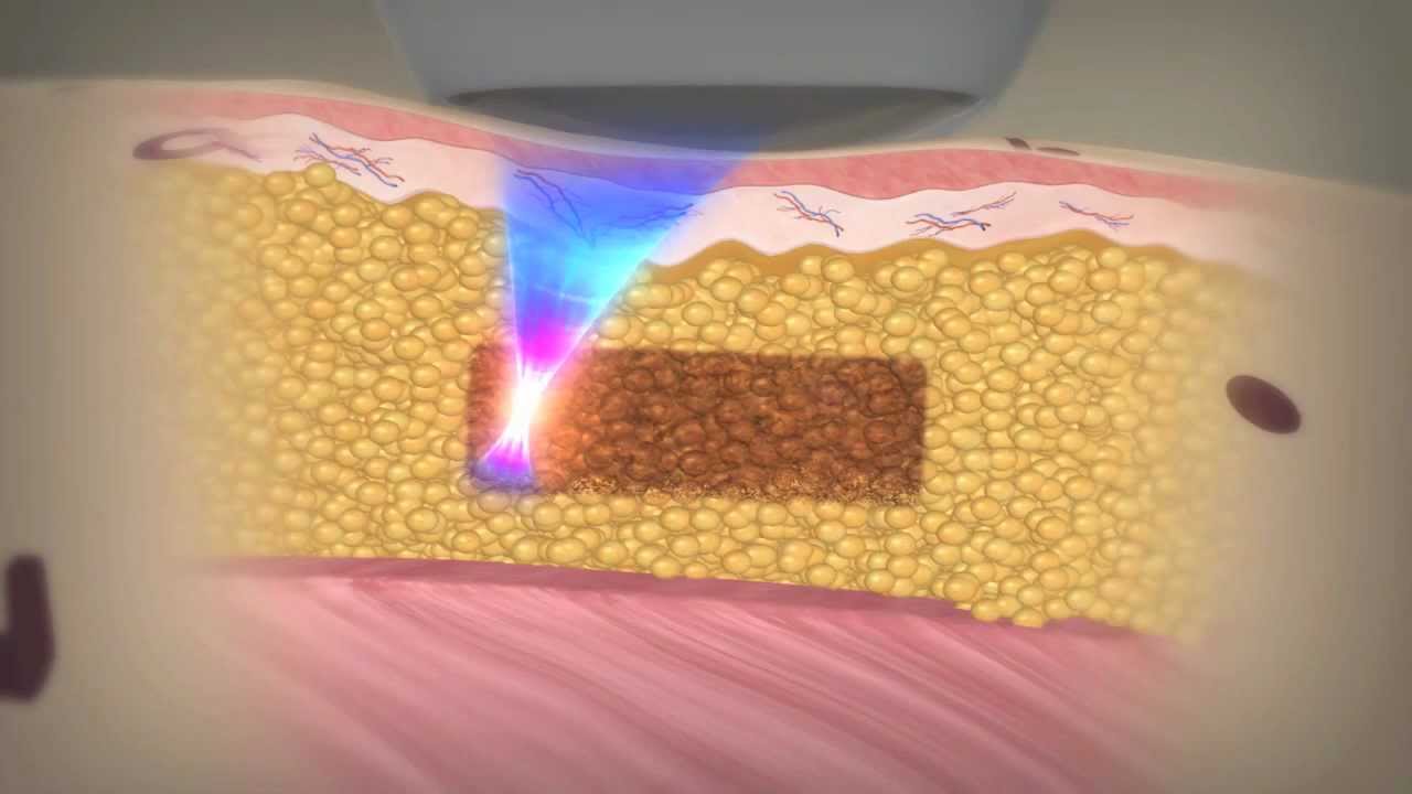 Liposonix Animation | Liposonix Treatment