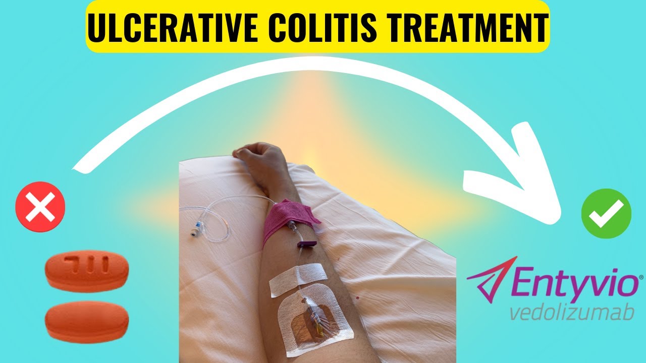 My Journey with Ulcerative Colitis: How Biologics Changed Everything