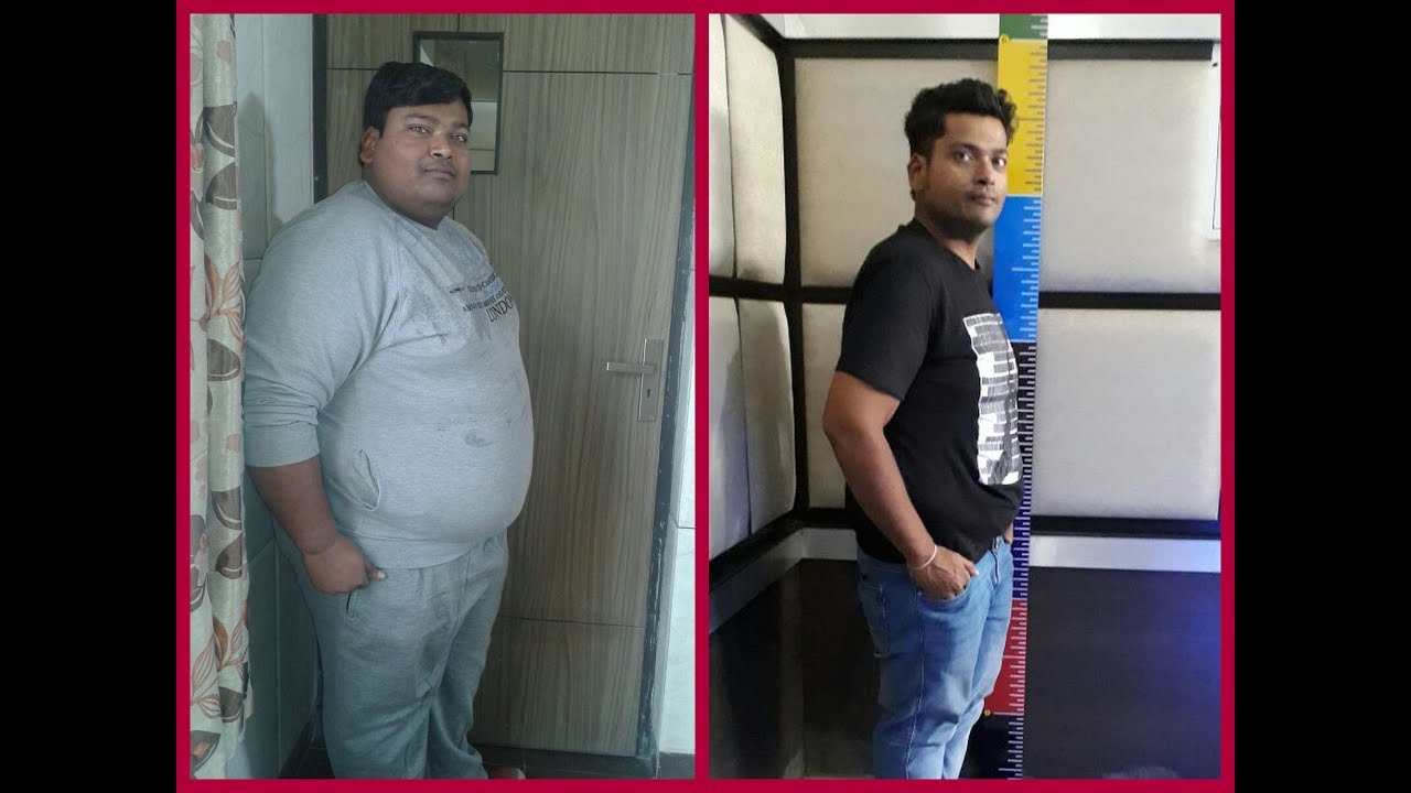 How I lost 77 kg| Best Weight loss story after Bariatric surgery| Best Bariatric surgeon in India|