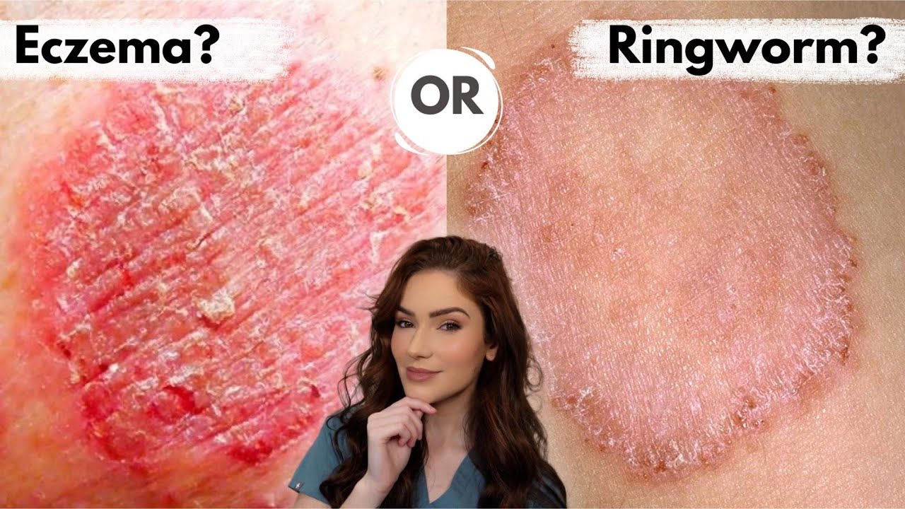 Eczema or Ringworm? | Derm Mimickers