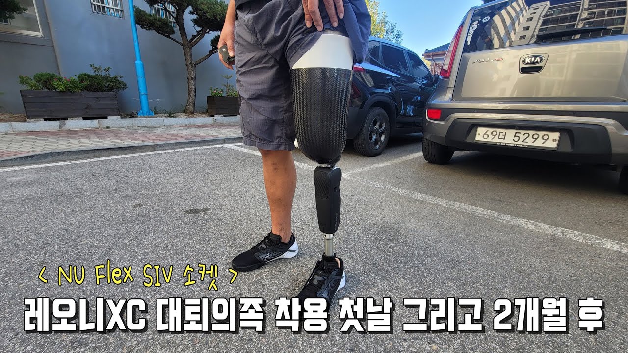 재활시작!! 레오니XC 대퇴의족 착용 첫날 그리고 2개월 후 (NU Flex SIV socket)