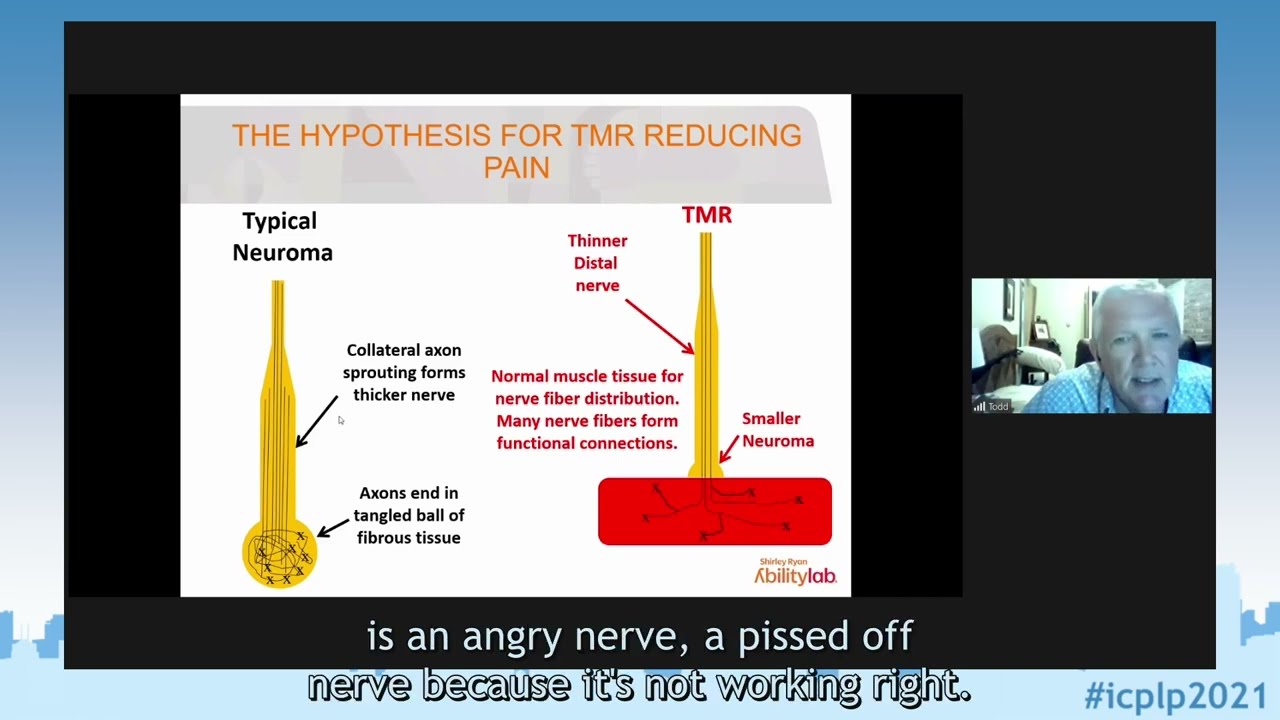 ICPLP2021 - Prof. Kuiken: Targeted Muscle Reinnervation for the treatment of Postamputation Pain