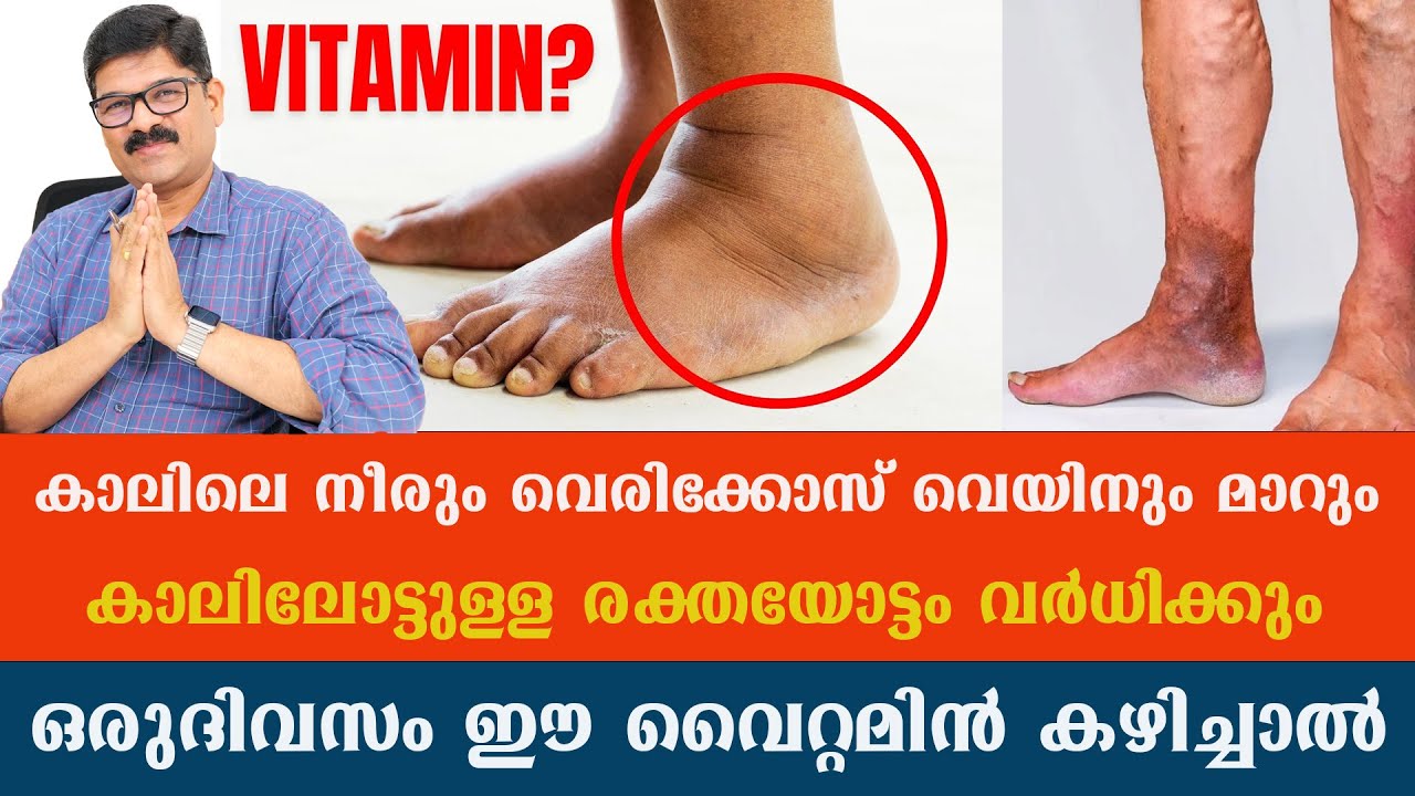 കാലിലെ നീരും വെരിക്കോസ് വെയിനും മാറും .കാലിലോട്ടുള്ള രക്തയോട്ടം വർധിക്കും  ഈ വൈറ്റമിൻ കഴിച്ചാൽ