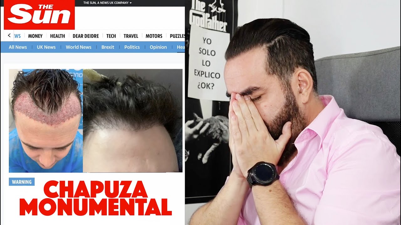 INJERTO CAPILAR - Chapuza monumental