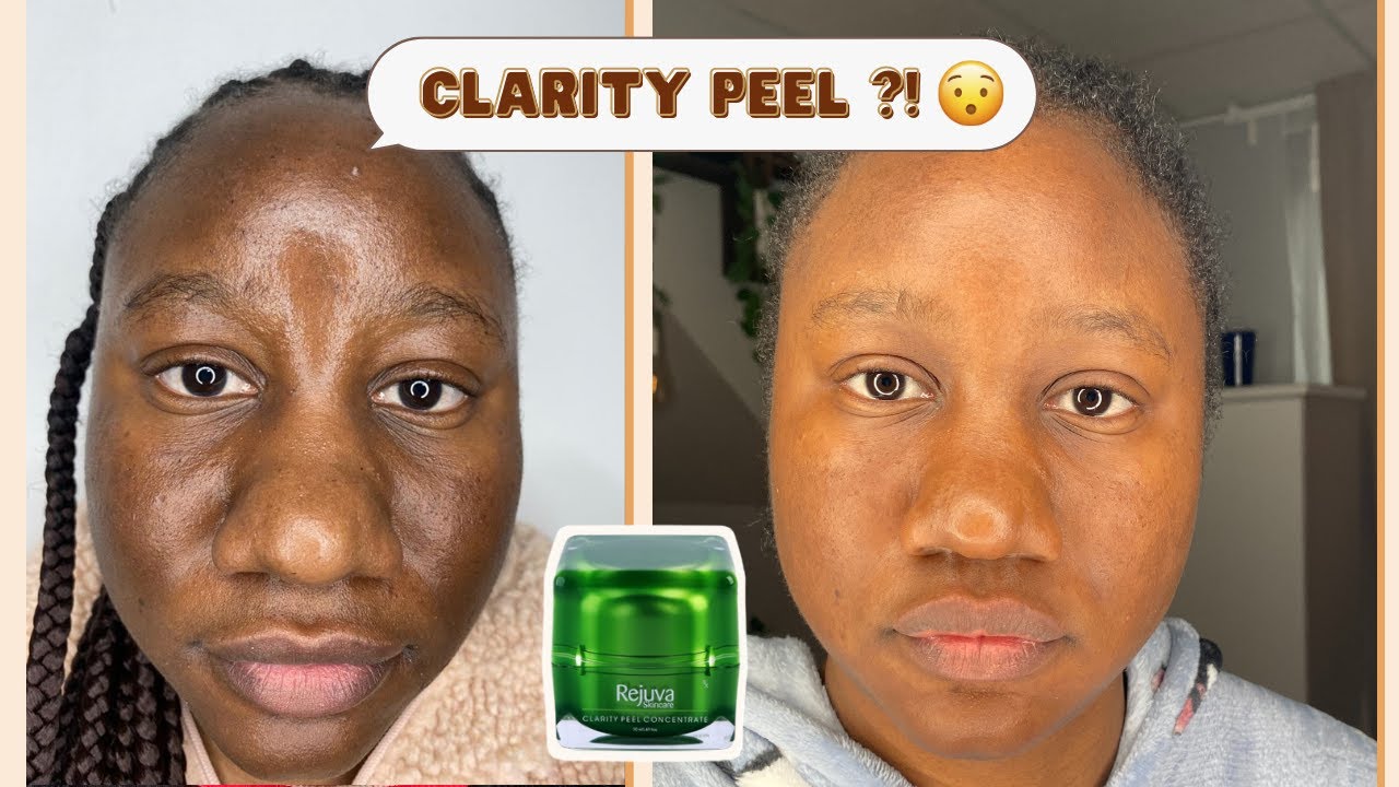 Microneedling & Peeling chimique I Procédure complète I Photos Avant / Après En-Fr