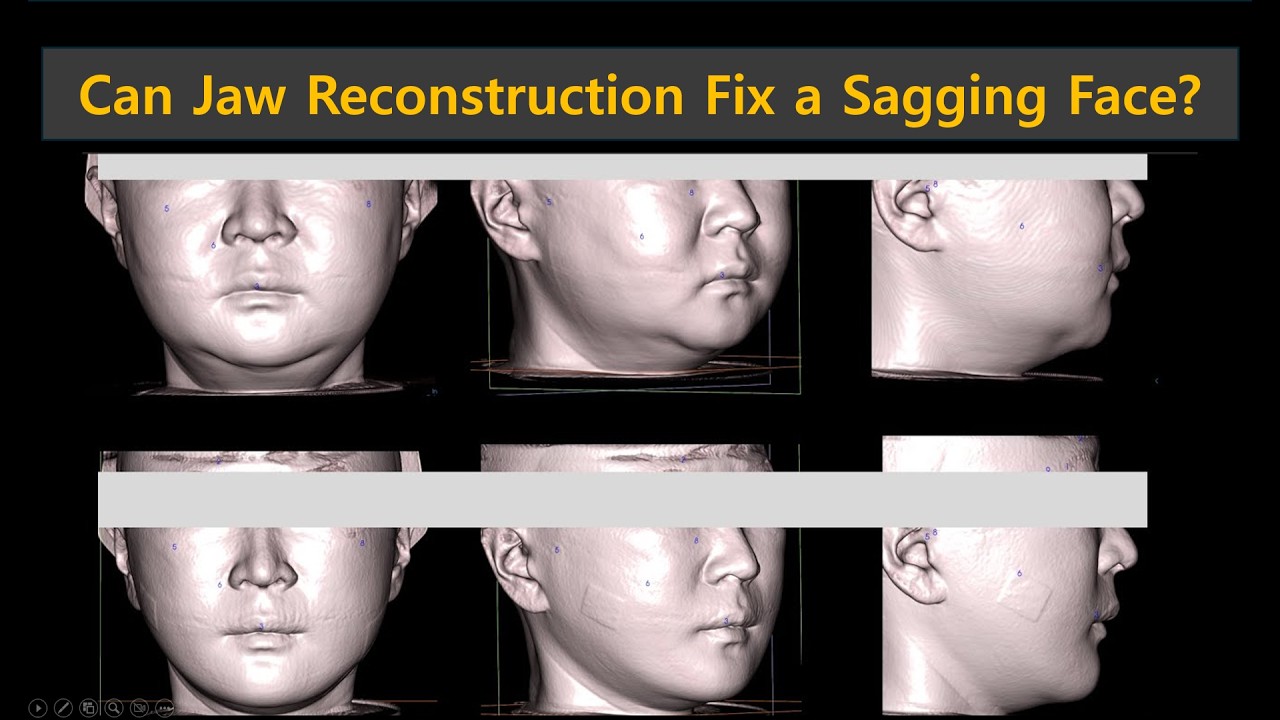 Can Jaw Reconstruction Fix a Sagging Face?  (PCL + Autologous Bone )