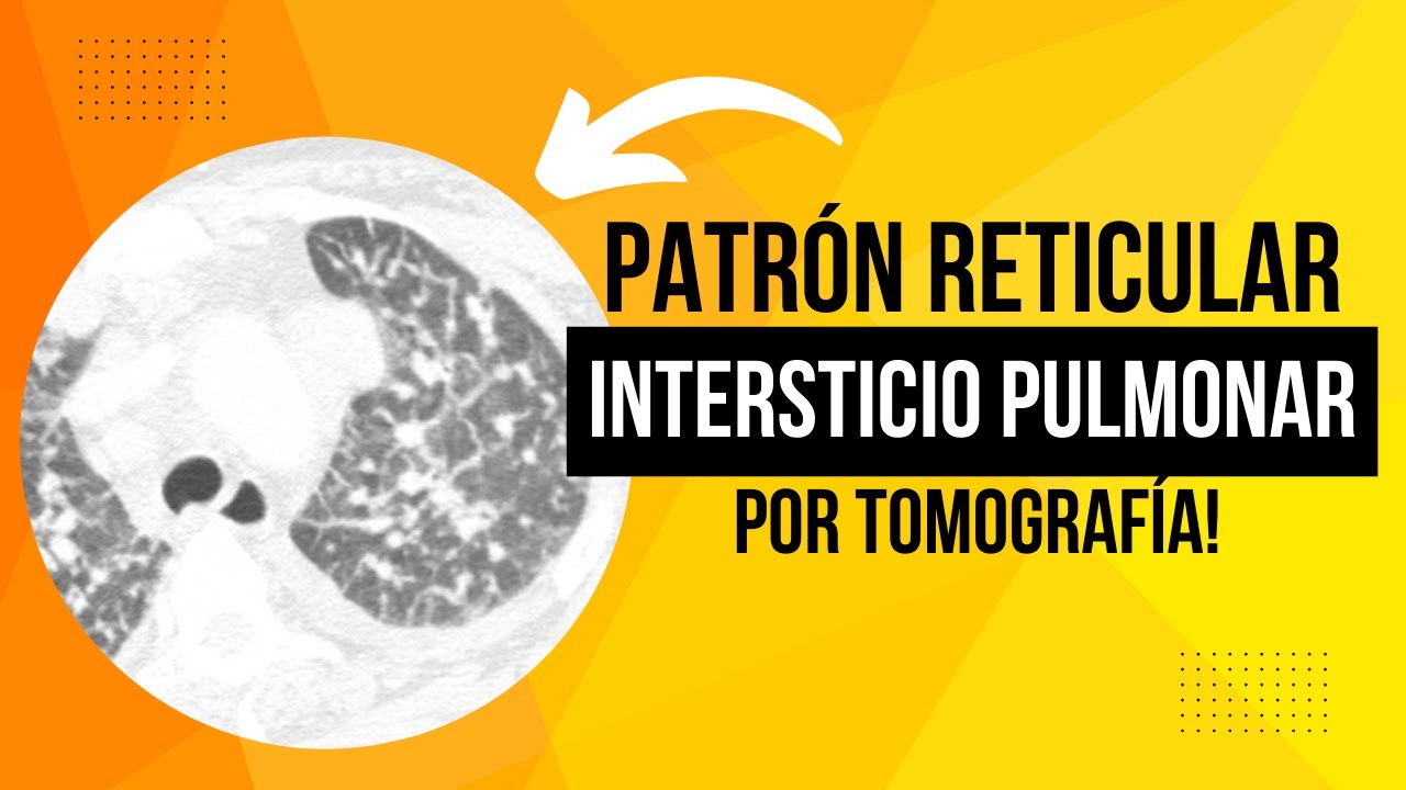 Qué es el intersticio pulmonar y cómo lo vemos por TC?📚✅