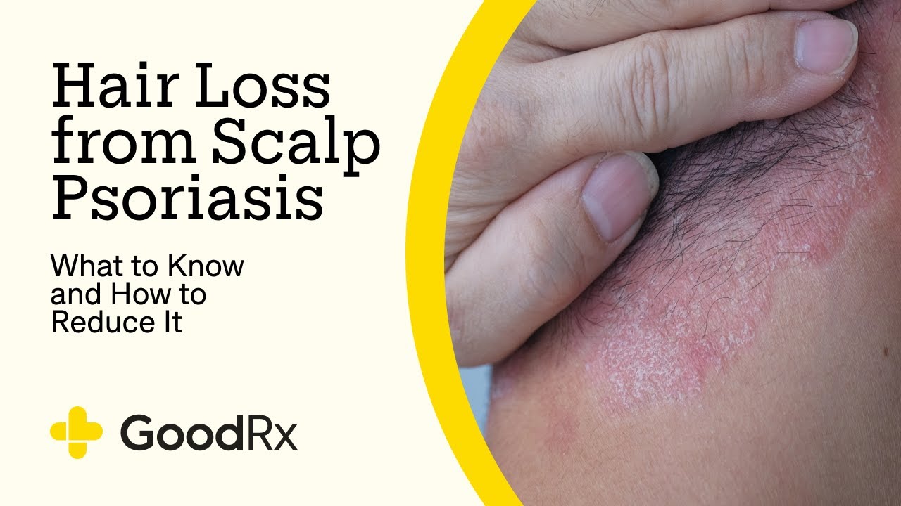 Hair Loss From Psoriasis on the Scalp: What to Know and What Helps | GoodRx