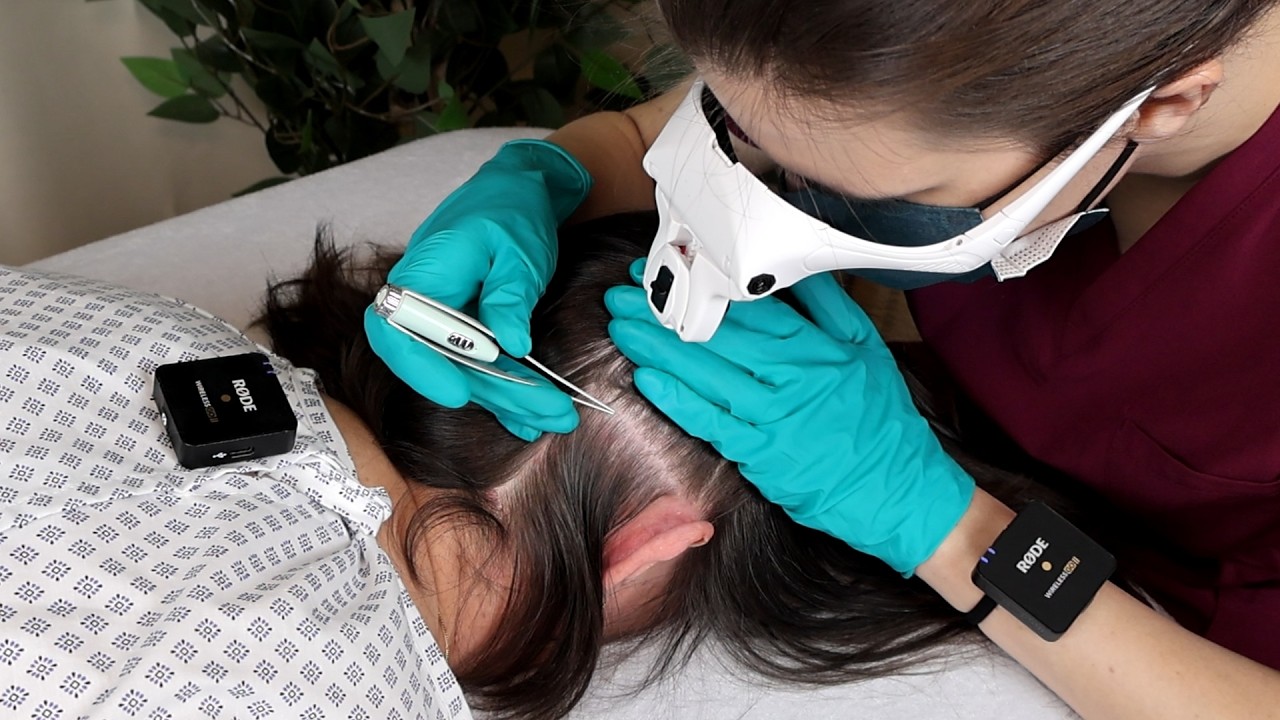 ASMR Removing LICE from Her Scalp and Neck | Lice Check with a Comb and Tweezers