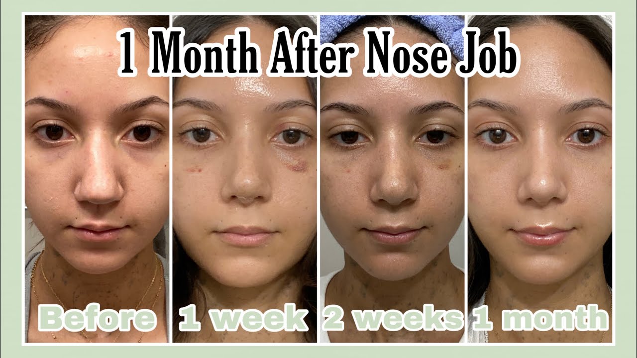 1 Month Rhinoplasty Update *With Pictures*