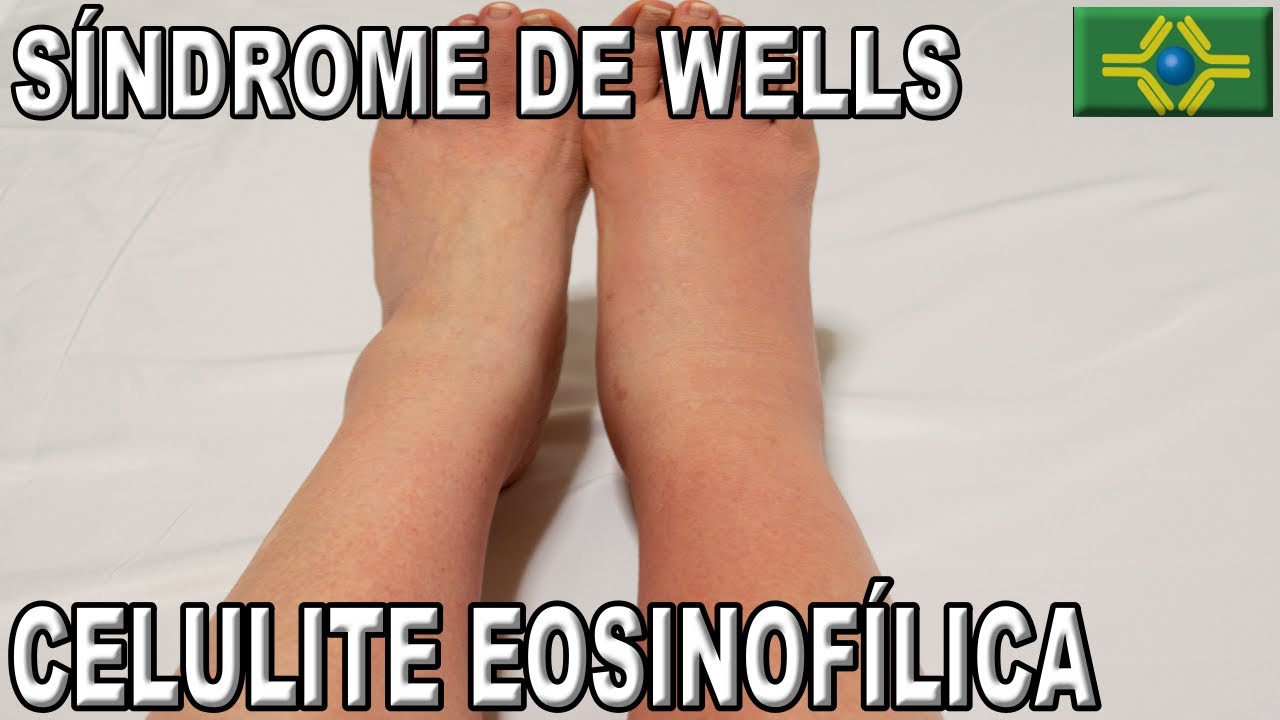 SÍNDROME DE WELLS | O que é a CELULITE EOSINIFÍLICA?