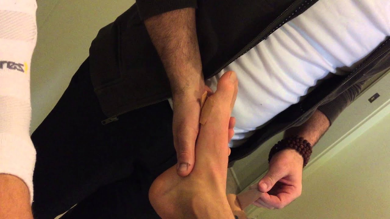 Tab Taping Technique for Seasmoiditis