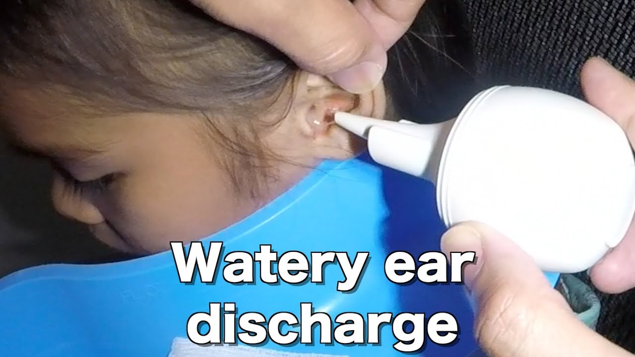 Little Girl's Ear Discharge Removal with Bulb Syringe