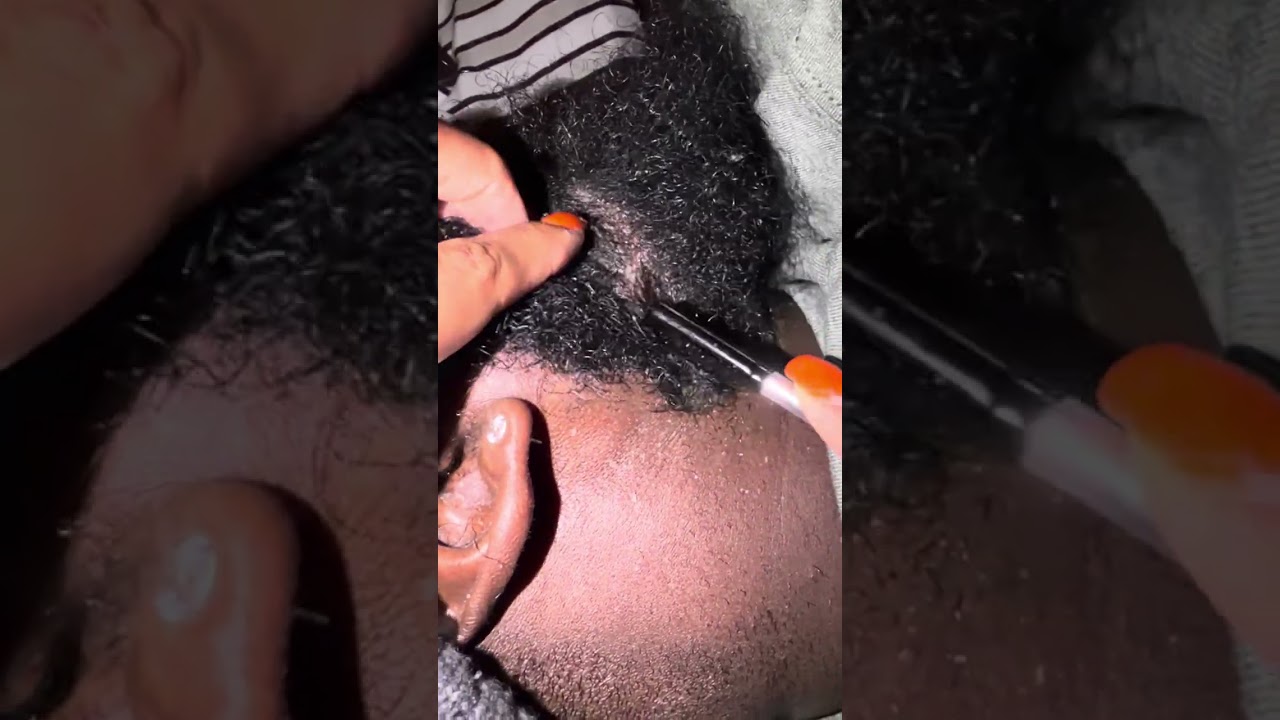 Beard Dandruff Scratching 