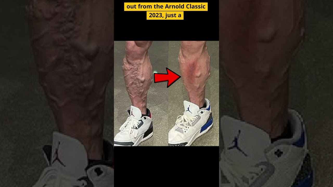 Nick's Varicose Veins Completely DISAPPEARED
