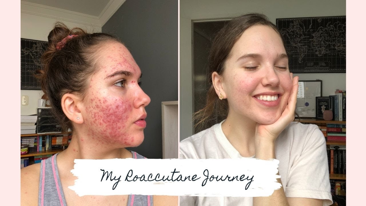 Roaccutane - My 6 Month Journey to Clear Skin