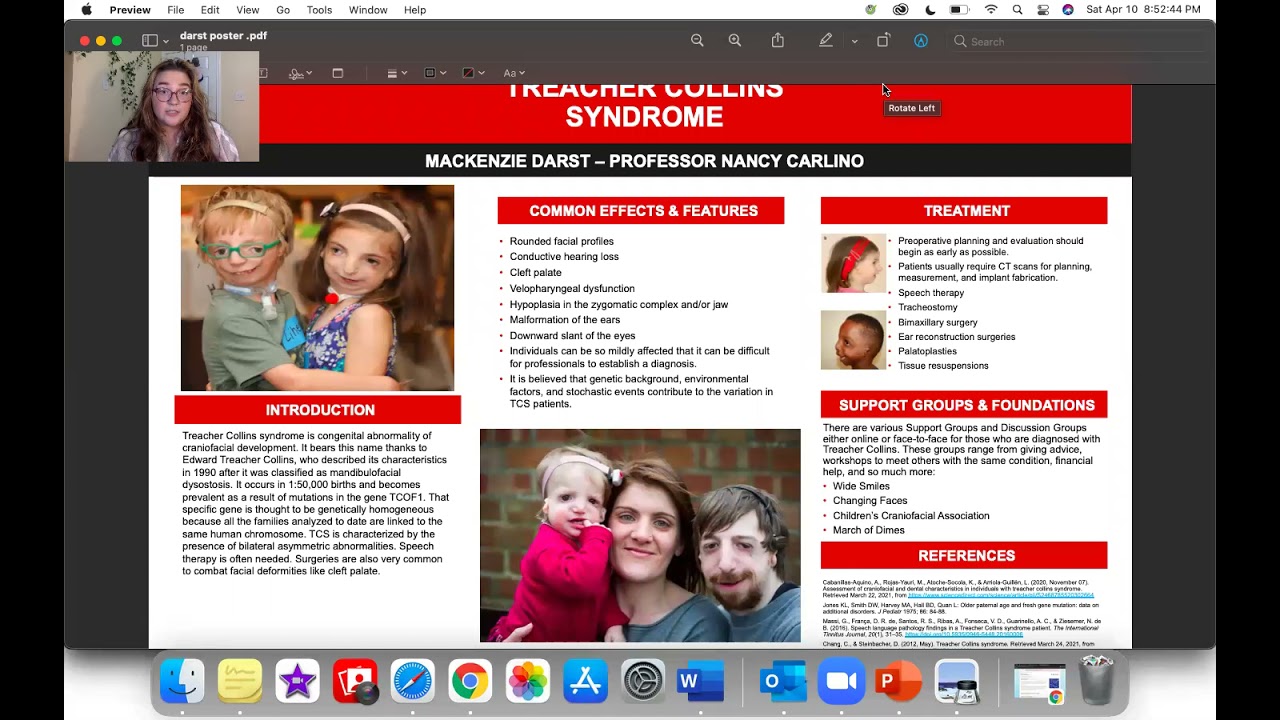 Treacher Collins Syndrome - MacKenzie Darst