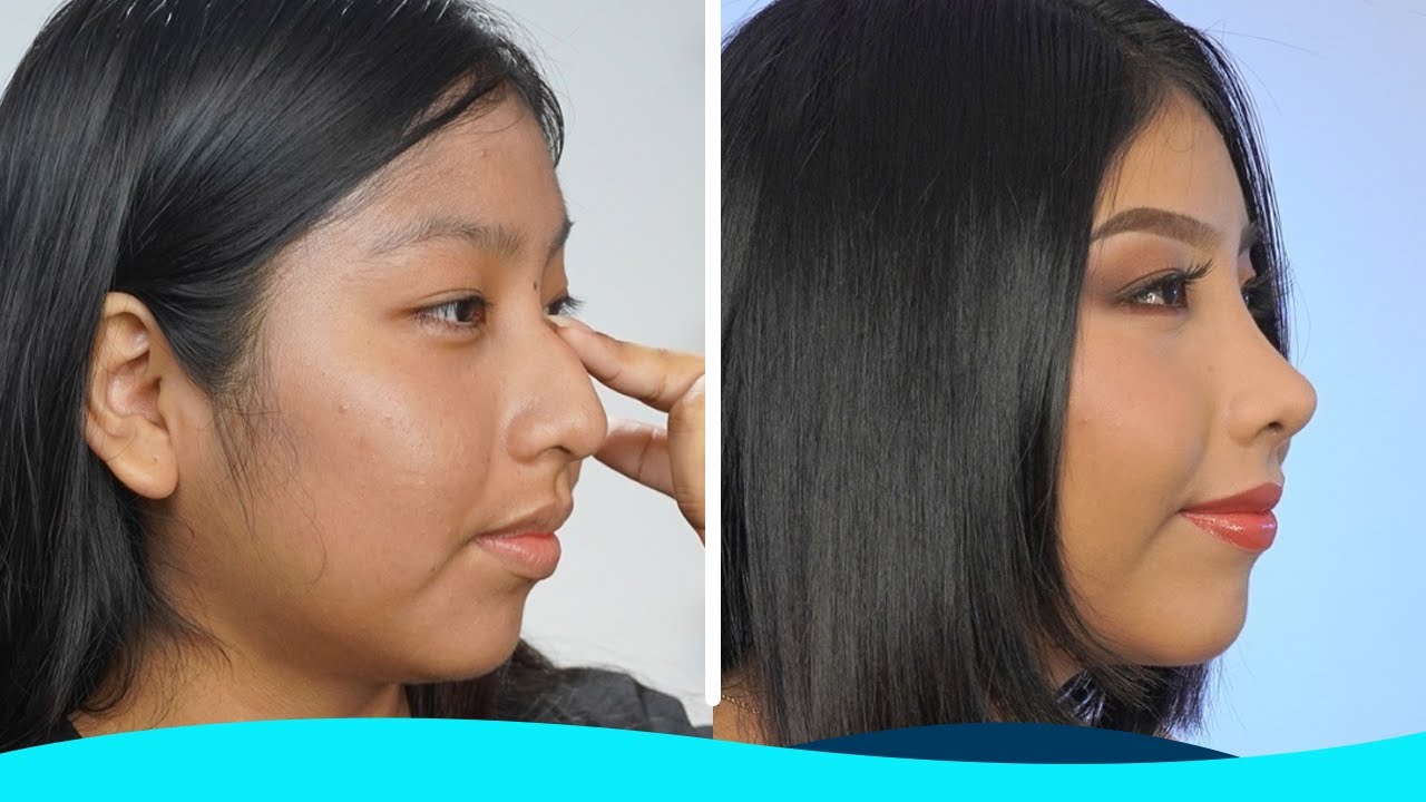 Rinoplastia Láser - Nayaly