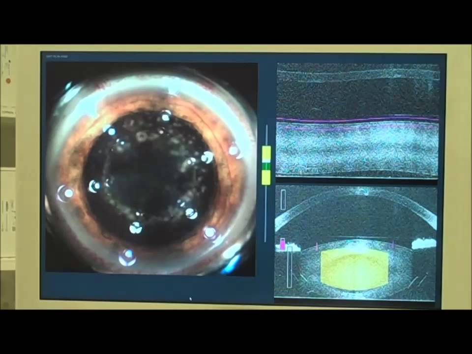 Dr  Robert Weinstock speaks about Bladeless Cataract Eye Surgery