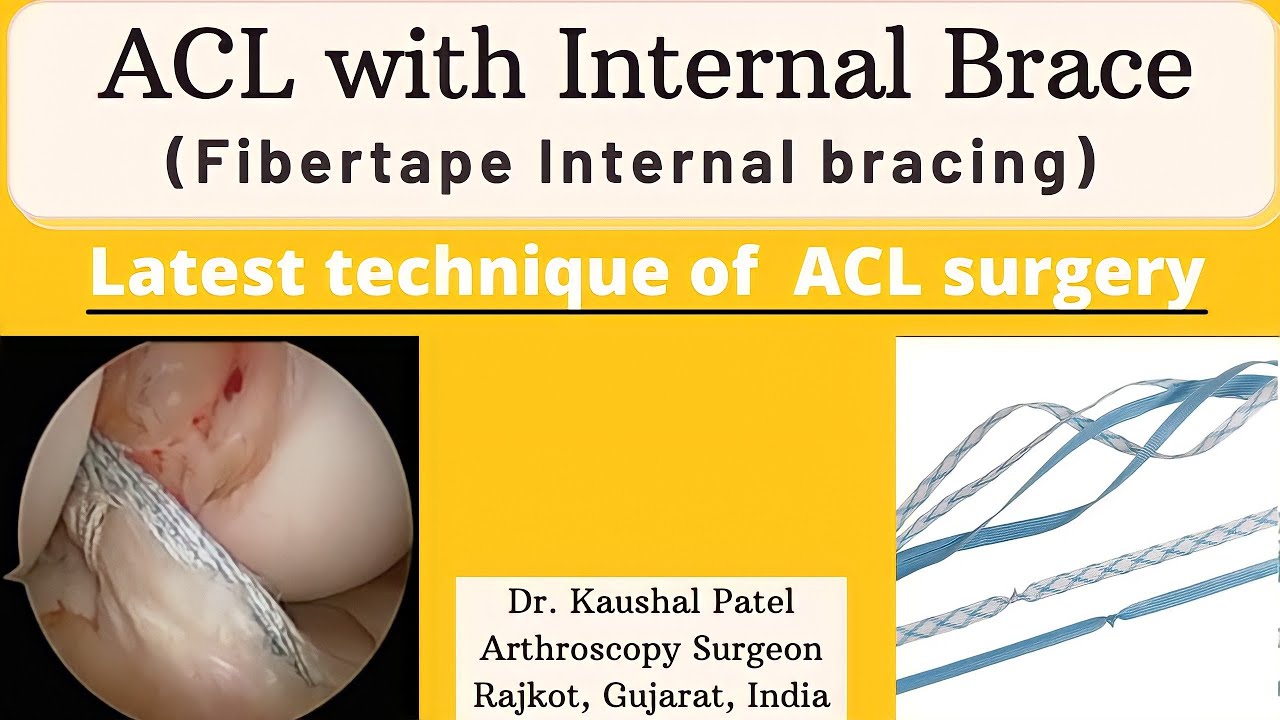 ACL with Internal bracing | Latest technique of ACL surgery #aclsurgery #internalbrace