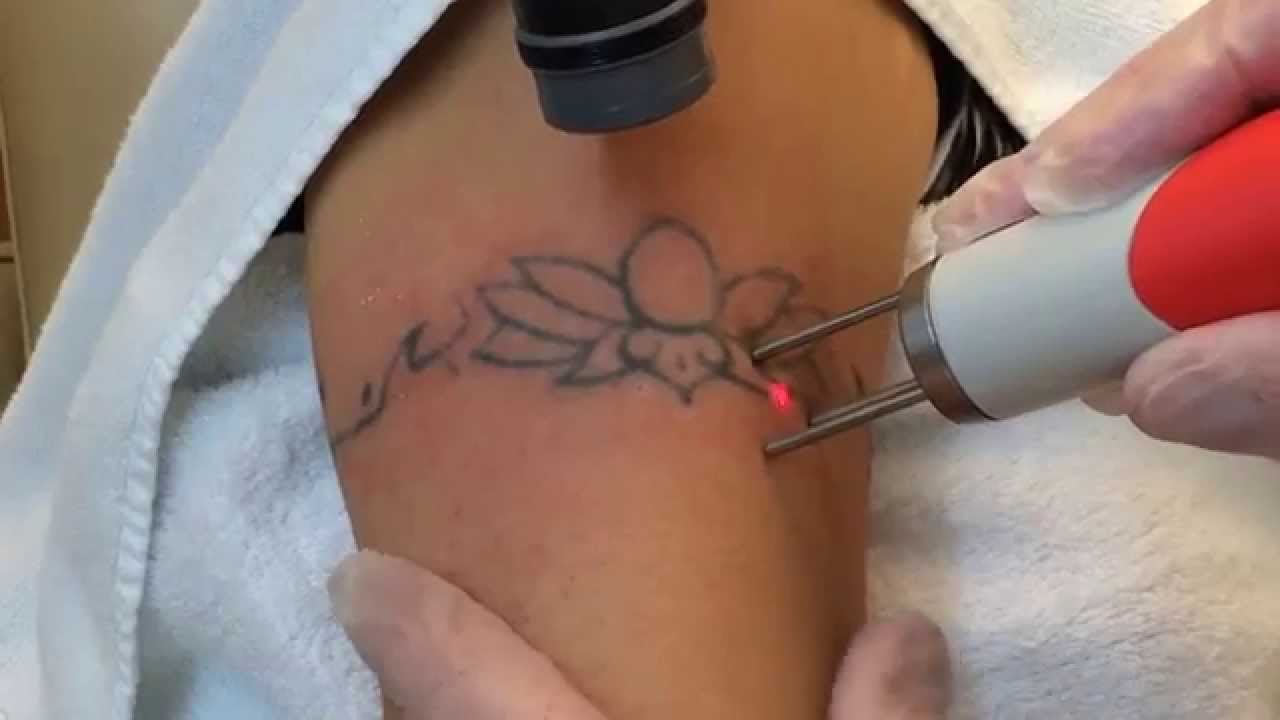 Dr. Robert Burke: Tattoo Removal With The Quanta Q-Plus C