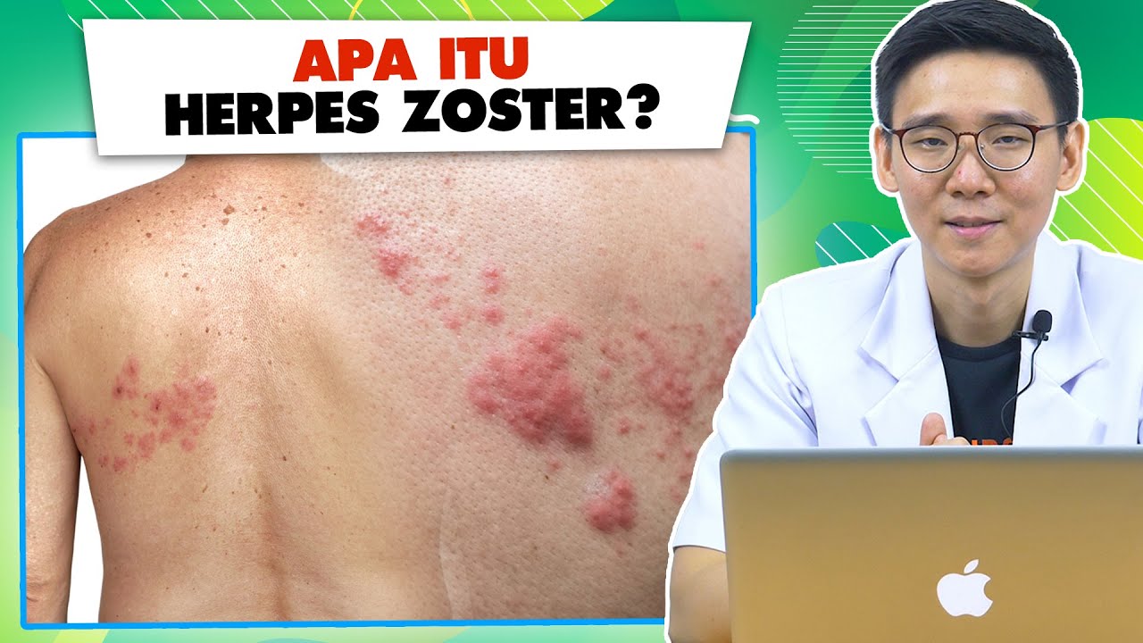 Apa Itu Herpes Zoster Atau Cacar Api?