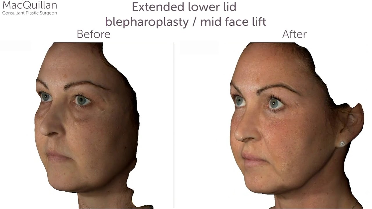 Facelift Before and After