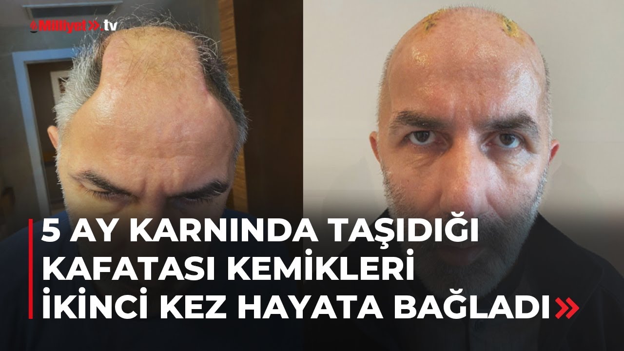 Karnında taşıdığı kafatası kemikleri ikinci kez hayata bağladı