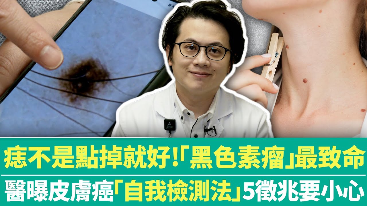 【健康療天室】痣不是點掉就好！「黑色素瘤」最致命　 醫曝皮膚癌「自我檢測法」5徵兆要小心｜中時新聞網