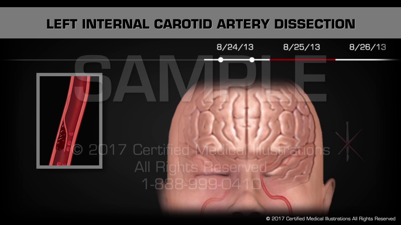 Carotid Artery Dissection Animated Timeline