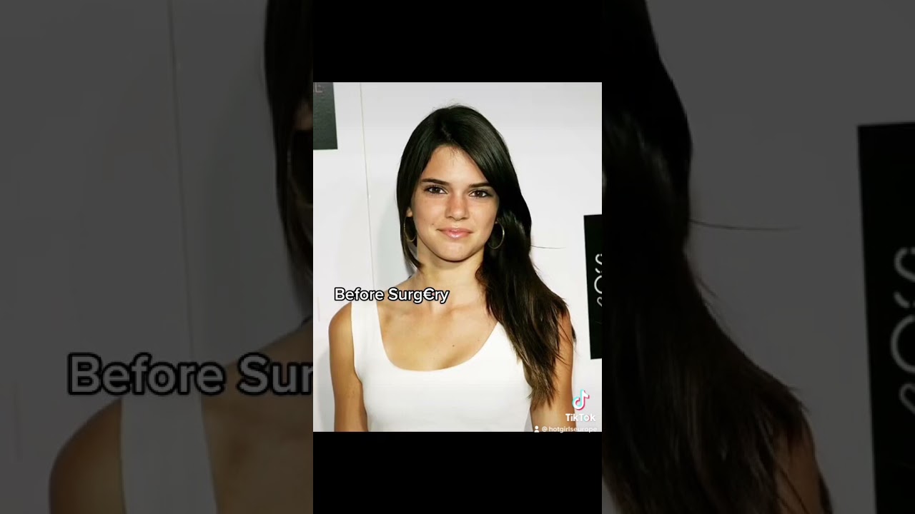 Kendall Jenner before and after plastic surgery