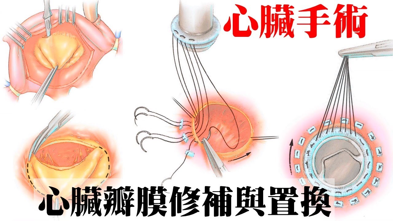 心臟衰竭手術：什麼是心臟瓣膜修補與置換｜許原彰醫師