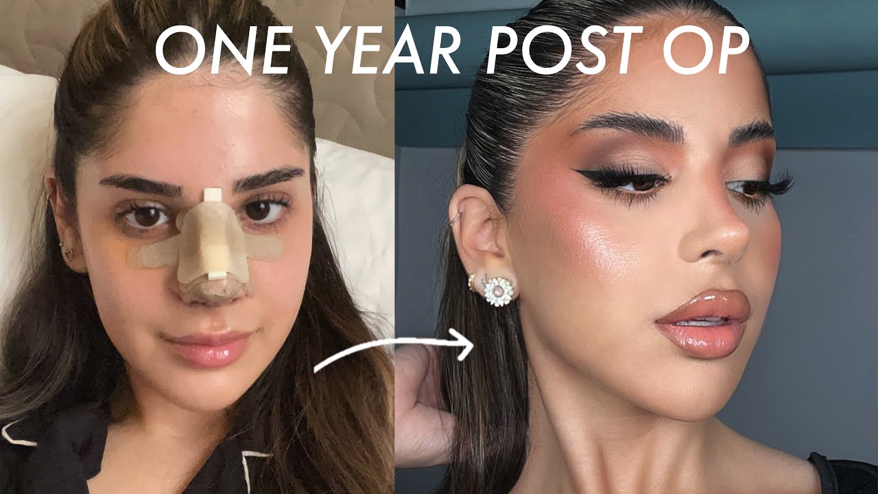 1 YEAR POST OP NOSE JOB UPDATE + Q&A