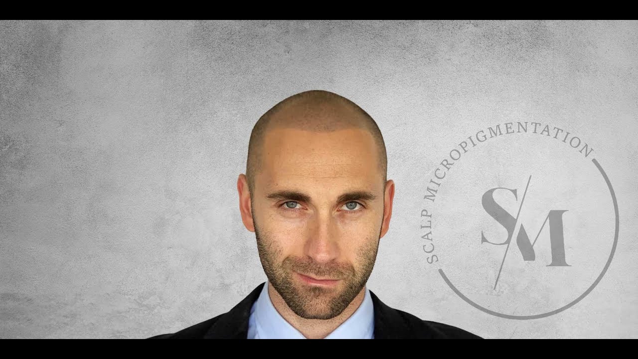 Scalp LA Client feedback #scalpmicropigmentation #hairloss