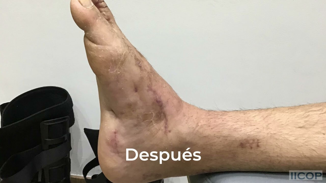 CADA PACIENTE CON CHARCOT MARIE TOOTH ES UN MUNDO Vídeo