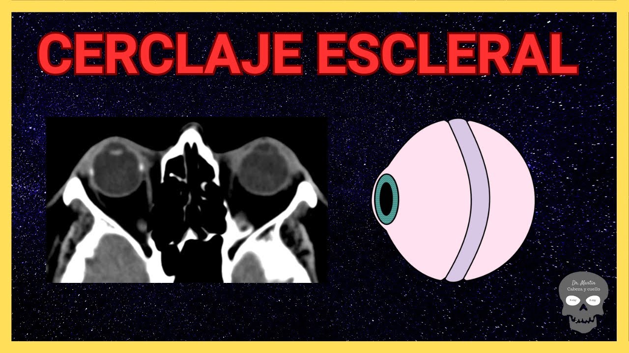 🩻 Cerclaje escleral en tomografía: hallazgos radiológicos esenciales 👁️