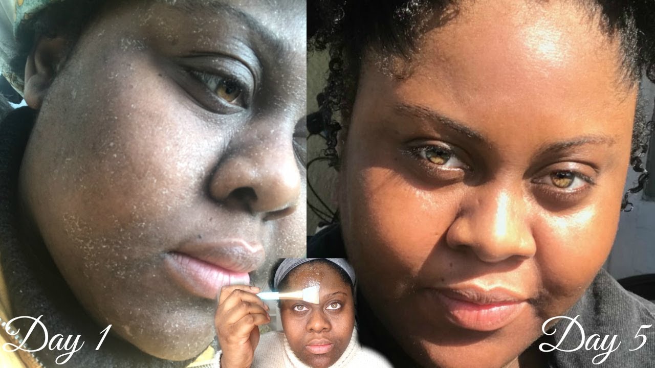 5 Day Aloe Vera + Manuka Honey Mask // THIS IS WHAT HAPPENED!