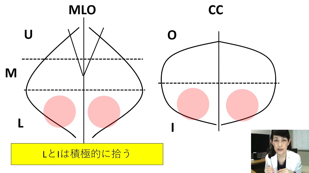 左右差を見るときのポイント　マンモグラフィを読影するときに目を付けるところはL（下）とO（上）！