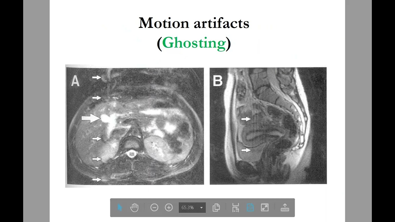 MRI physics of common MRI Artifacts